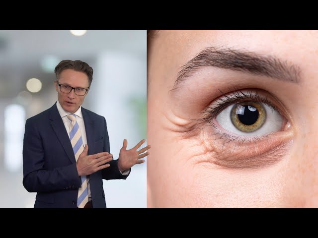 Lower Eyelid Surgery Explained by Dr. James Southwell-Keely